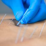 Acupuntura se torna aliada na recuperação de pacientes de cirurgia ortopédica